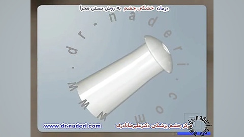 درمان خشکی چشم با بستن مجرای- مرکز چشم پزشکی دکتر نادری مرکز چشم پزشکی دکتر علیرضا نادری www.dr-naderi.com