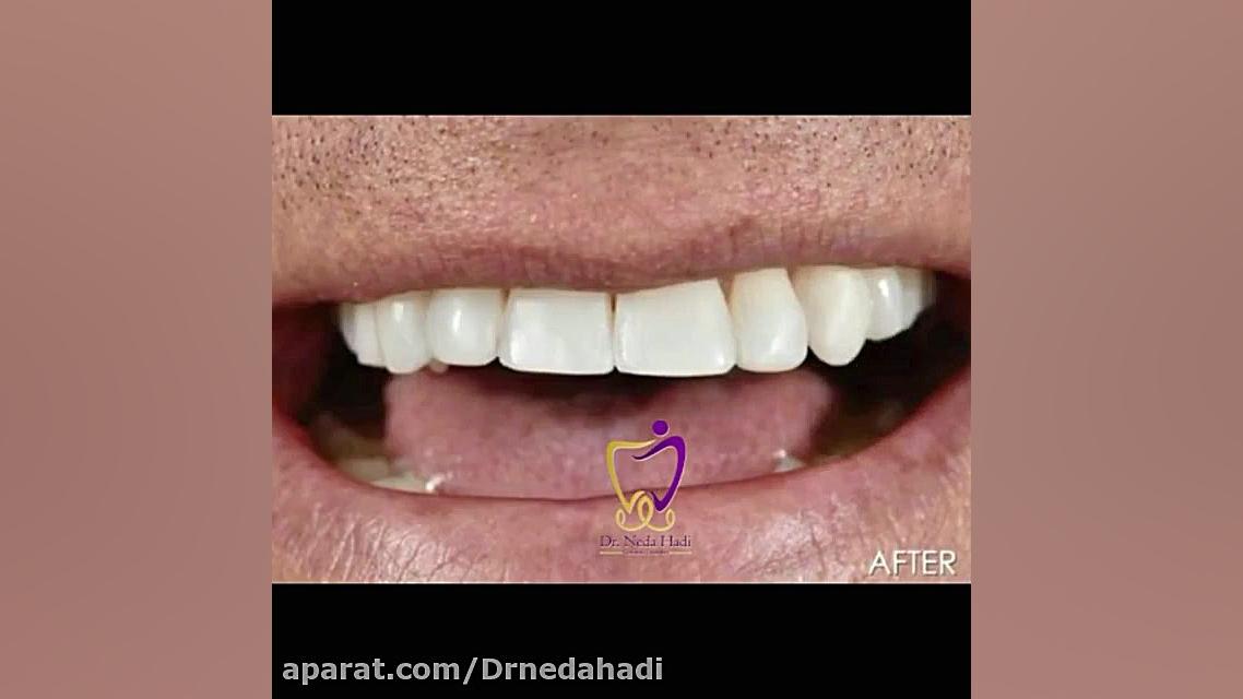 اصلاح طرح لبخند توسط دکتر ندا هادی دکتر ندا هادی-دندانپزشک زیبایی