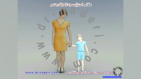 علائم استرابیسم - مرکز چشم پزشکی دکتر علیرضا نادری مرکز چشم پزشکی دکتر علیرضا نادری www.dr-naderi.com