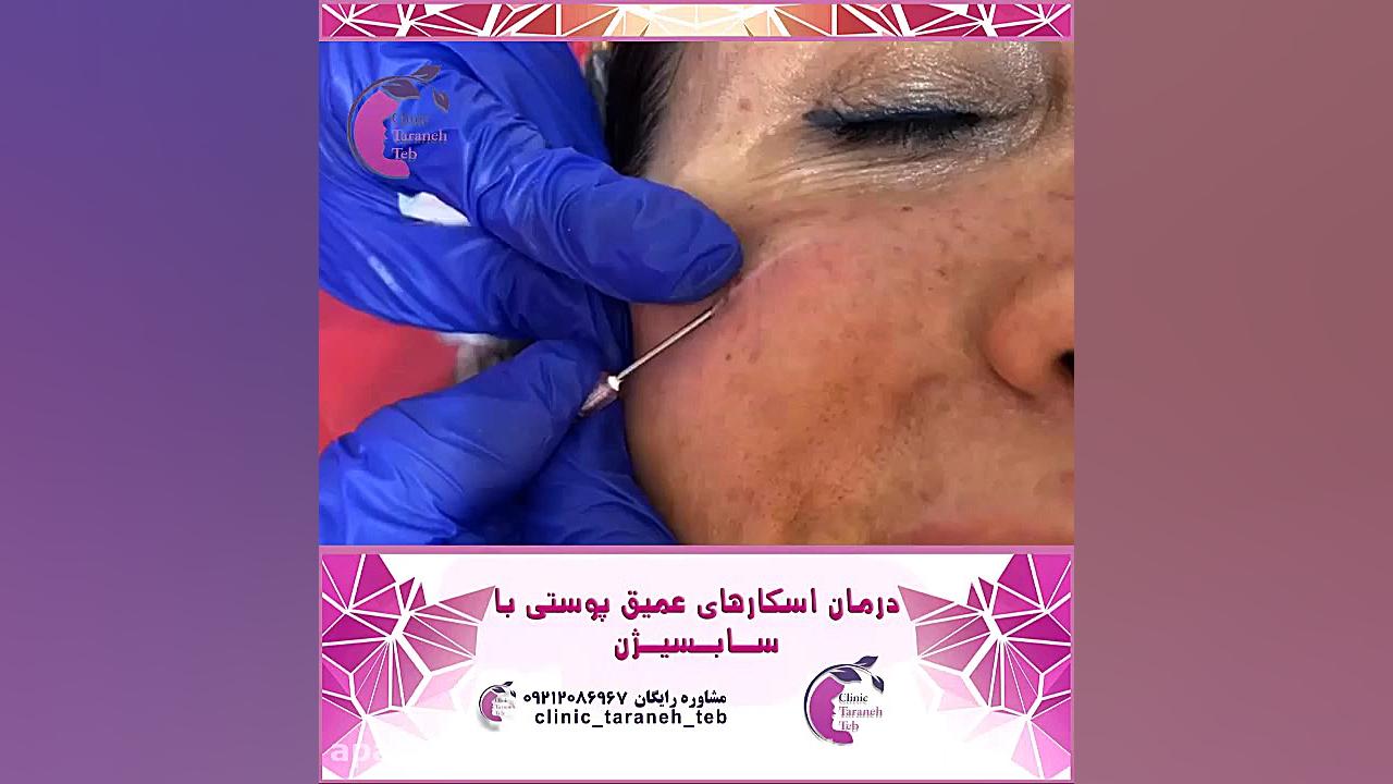 سابسیژن پوست تزریق بوتاکس