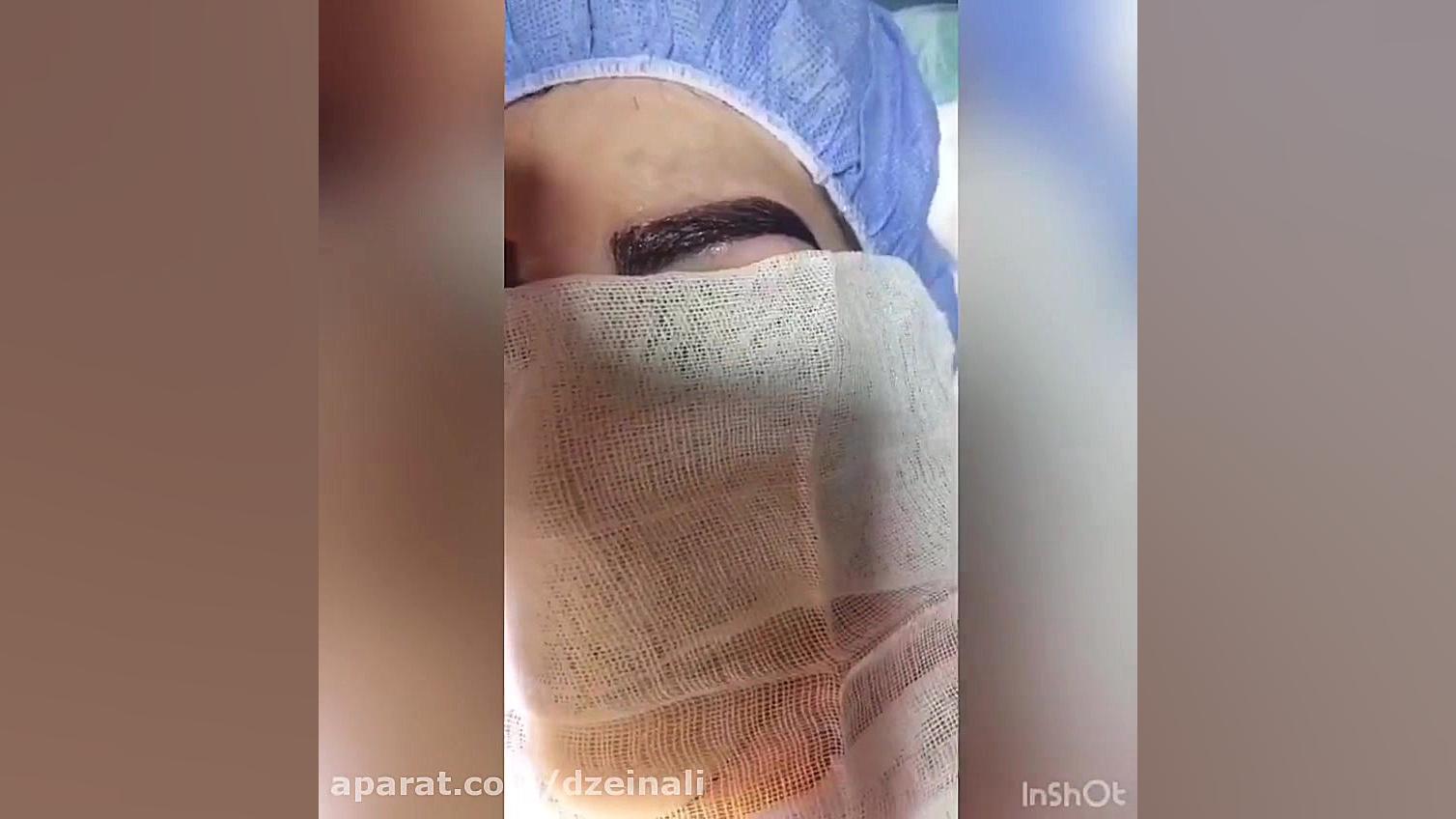 کاشت ابروی دائمی دکتر فرحناز زینعلی - متخصص پوست، مو، زیبایی زنجان
