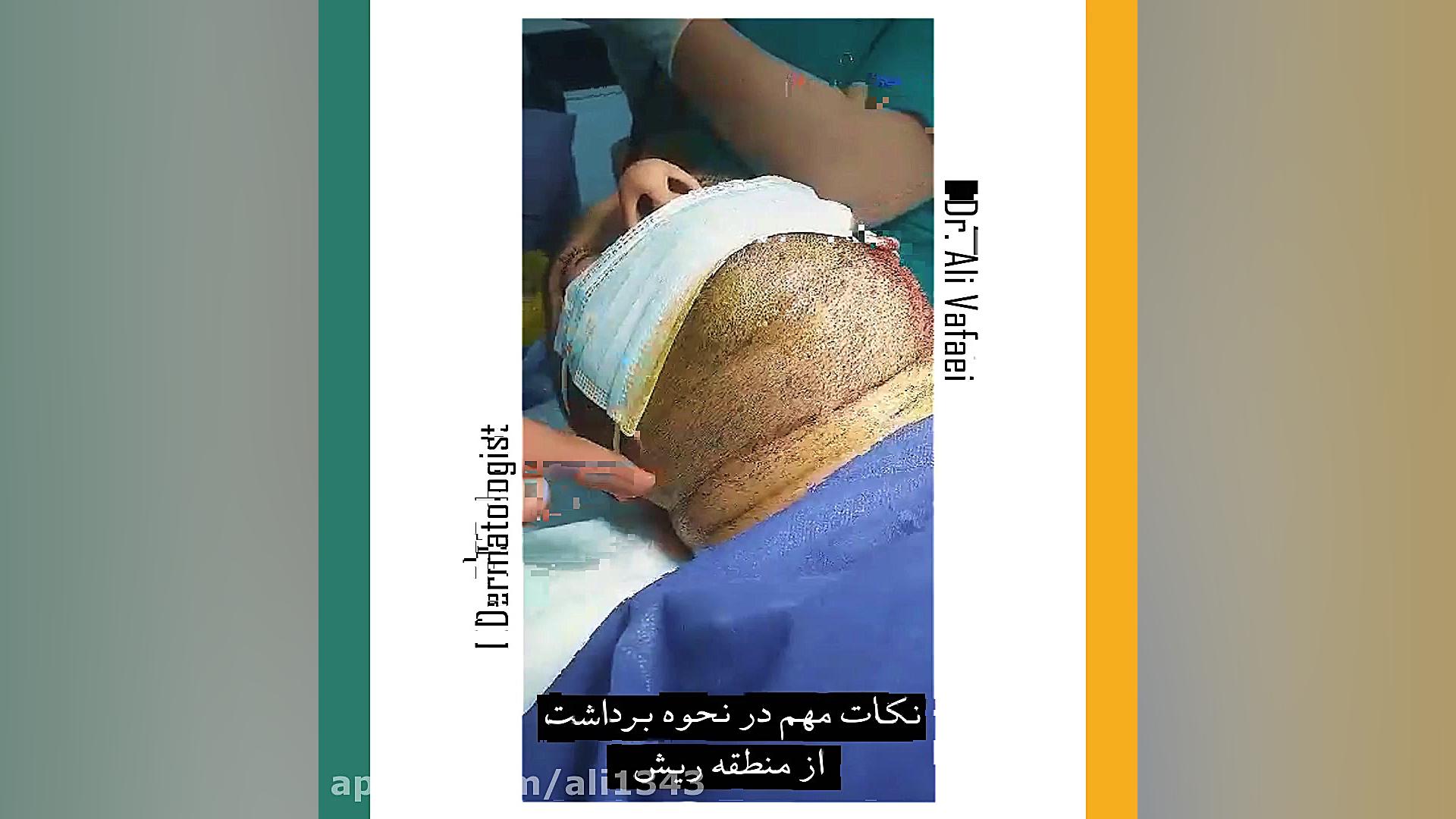 برداشت از منطقه ریش به روش FIT دکتر علی وفائی - متخصص پوست و مو