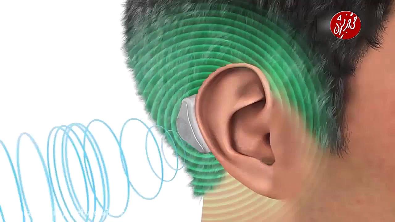 ADHEAR دستگاهی برای کمک به افراد دارای مشکل شنوایی جراحی زیبایی پلک