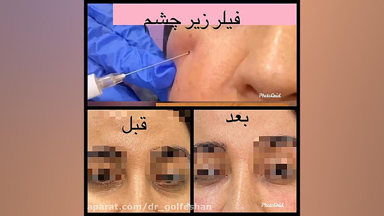 رفع گودی و تیرگی زیر چشم با تزریق فیلر یا ژل دکتر عاطفه گلفشان، متخصص پوست مو و لیزر درمانی