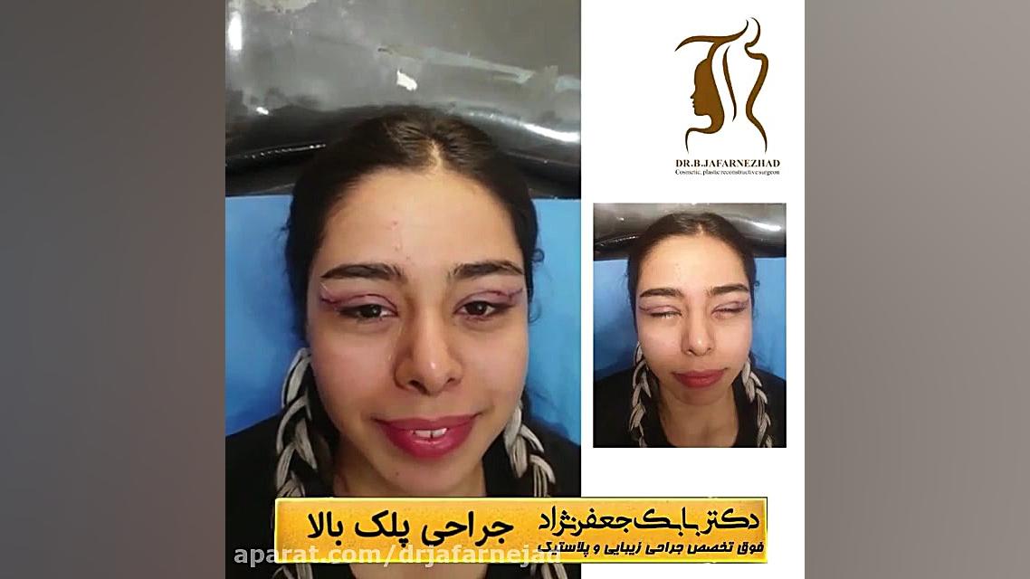 بلفاروپلاستی یا جراحی زیبایی چشم دکتر بابک جعفرنژاد
