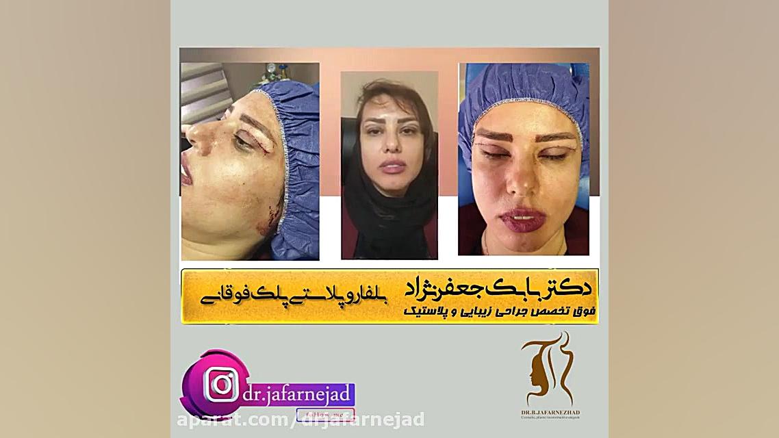 فیلم بلفاروپلاستی پلک بالا دکتر بابک جعفرنژاد
