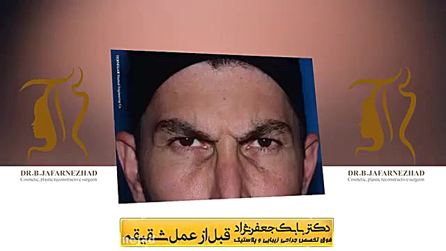 فیلم لیفت شقیقه دکتر بابک جعفرنژاد