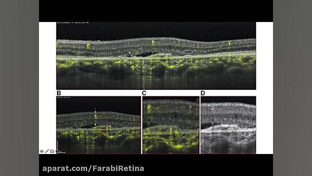 Chronic Neovascular CSC - Stress/Rest OCTA study بیلی آیلیش