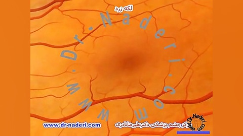 لکه زرد شبکیه -ساختمان چشم-مرکز چشم پزشکی دکترنادری مرکز چشم پزشکی دکتر علیرضا نادری www.dr-naderi.com