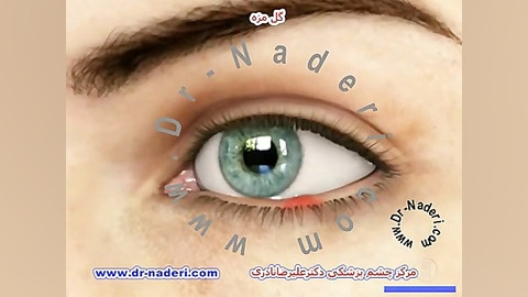 گل مژه - مرکز چشم پزشکی دکتر علیرضا نادری مرکز چشم پزشکی دکتر علیرضا نادری www.dr-naderi.com