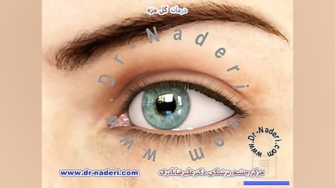 درمان گل مژه - مرکز چشم پزشکی دکتر علیرضا نادری مرکز چشم پزشکی دکتر علیرضا نادری www.dr-naderi.com