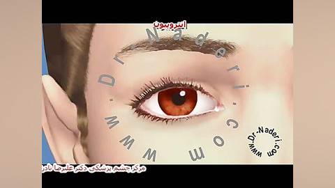 انتروپیون - مرکز چشم پزشکی دکتر علیرضا نادری مرکز چشم پزشکی دکتر علیرضا نادری www.dr-naderi.com