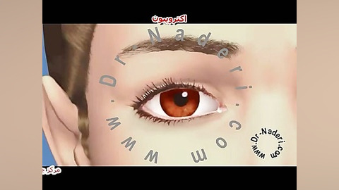 اکتروپیون - مرکز چشم پزشکی دکتر علیرضا نادری مرکز چشم پزشکی دکتر علیرضا نادری www.dr-naderi.com