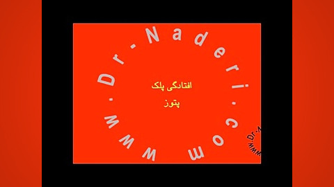 پتوز یا افتادگی پلک - مرکز چشم پزشکی دکتر علیرضا نادری مرکز چشم پزشکی دکتر علیرضا نادری www.dr-naderi.com