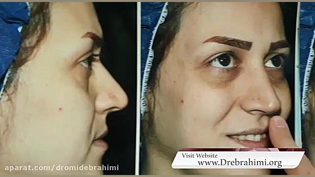 جراحی بینی استخوانی توسط دکتر امید ابراهیمی بهترین جراح بینی دکتر امید ابراهیمی