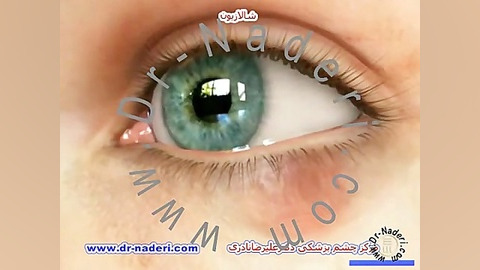 شالازیون - مرکز چشم پزشکی دکتر علیرضا نادری مرکز چشم پزشکی دکتر علیرضا نادری www.dr-naderi.com