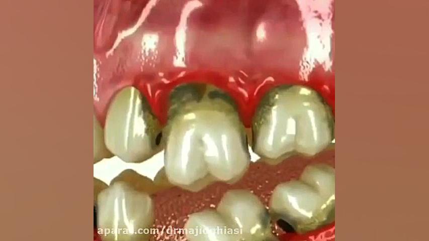 پوسیدگی-دکترمجیدقیاسی دندانپزشک زیبایی مشهد دکترمجیدقیاسی