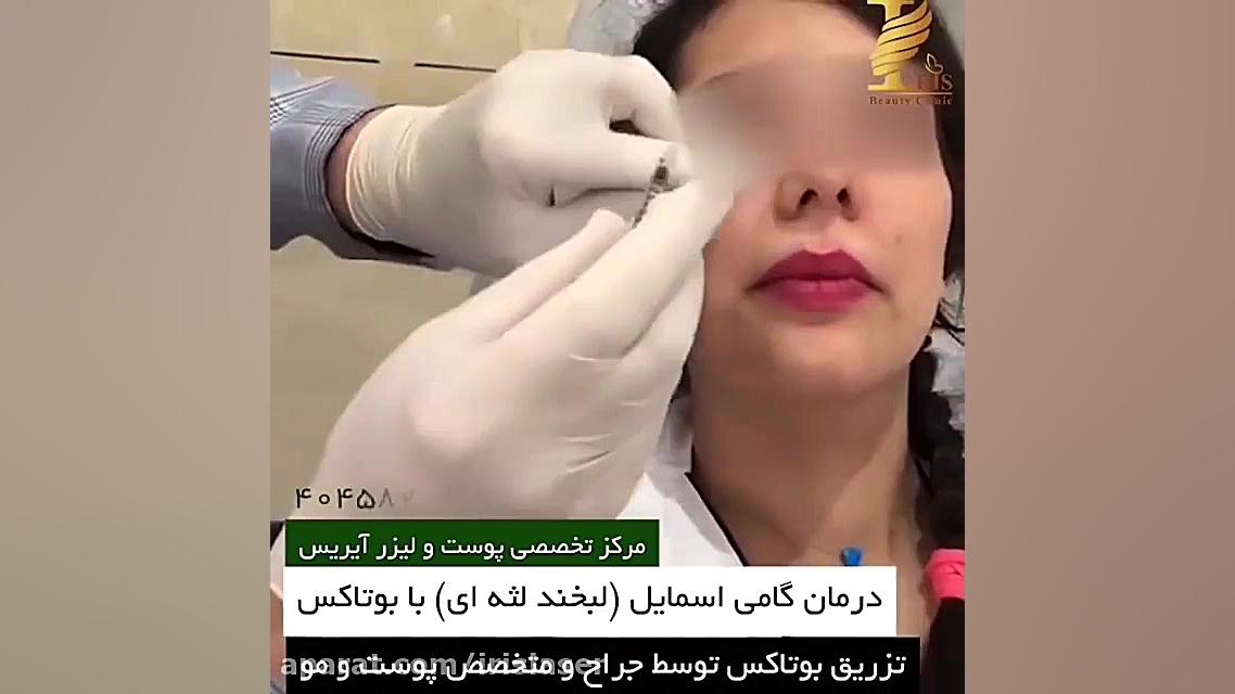 درمان لبخند لثه ای والسارتان