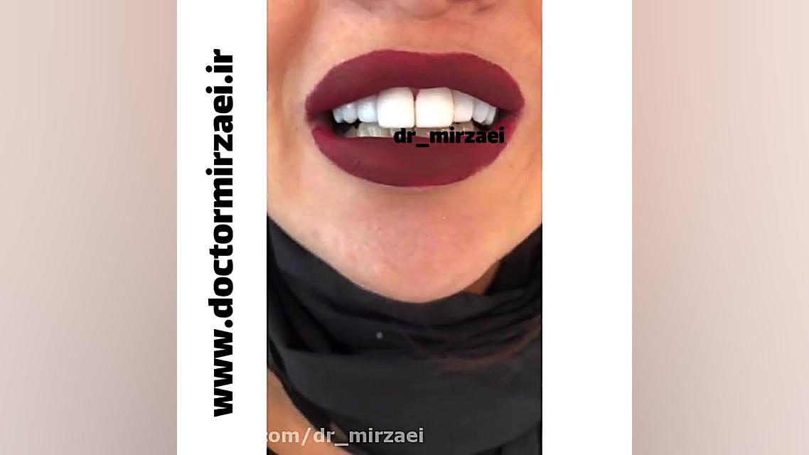 اصلاح طرح لبخند پیلینگ