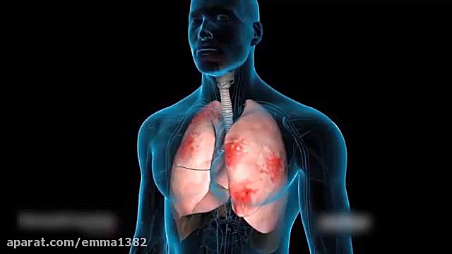 ذات الریه.. بیماری خطرناک جراحی بینی