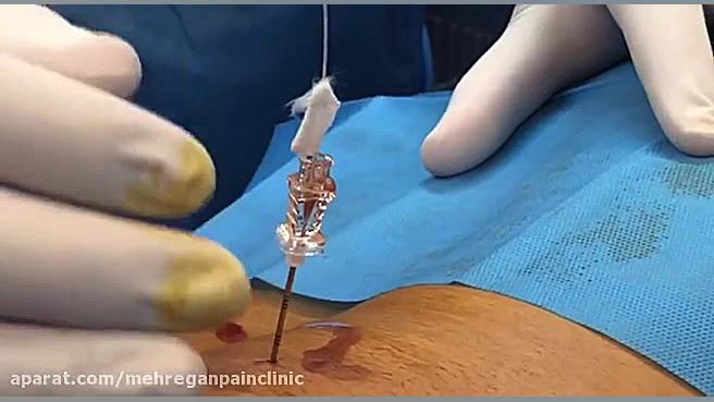 عمل لیزر دیسک کمر بدون بیهوشی .کلینیک درد مهرگان کلینیک مو