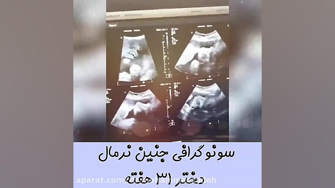 جنین زیبای ۳۱ هفته لاکپشت رقصان