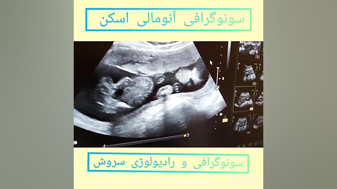 فیلم انومالی اسکن همراه با توضیحات خانم دکتر کلیپ ضدحال