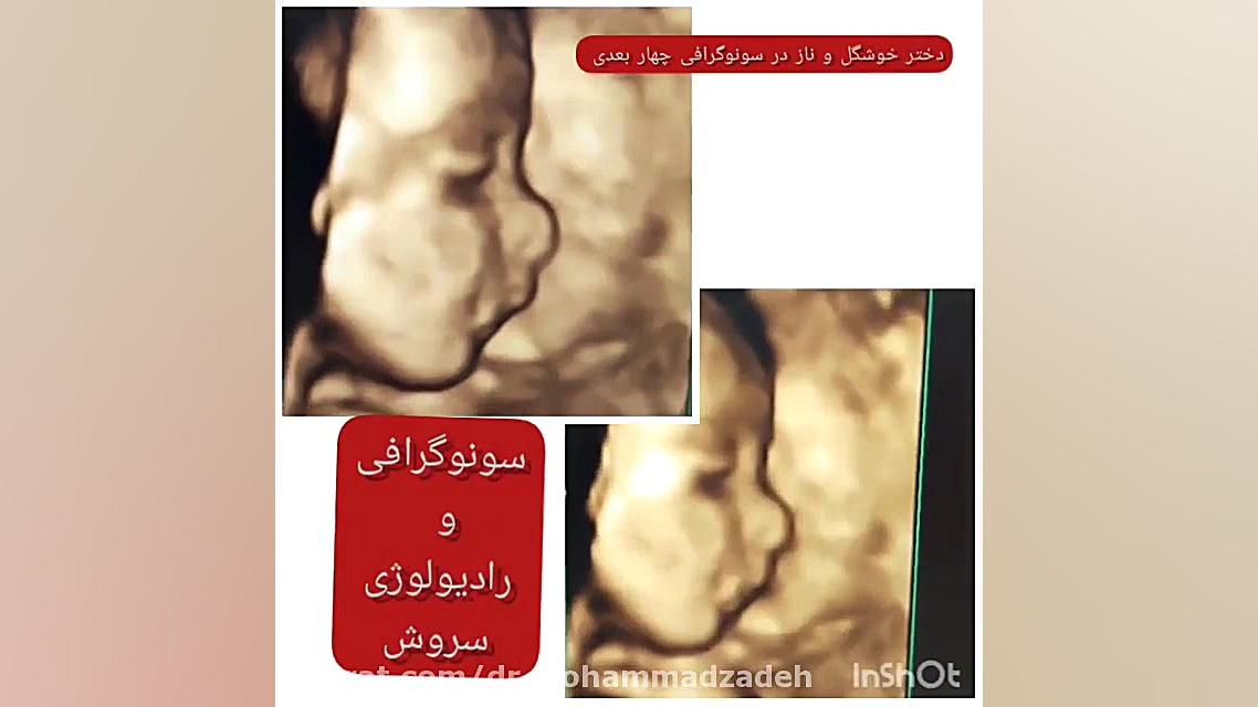 سونوگرافی 4 بعدی کلاغ آنلاین