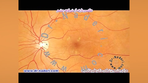 عکسبرداری از شبکیه - مرکز چشم پزشکی دکتر علیرضا نادری مرکز چشم پزشکی دکتر علیرضا نادری www.dr-naderi.com