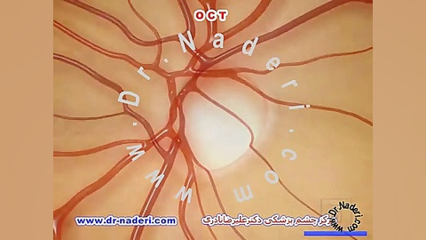 تصویربرداری اپتیکی شبکیهOCT - مرکز چشم پزشکی دکترنادری مرکز چشم پزشکی دکتر علیرضا نادری www.dr-naderi.com