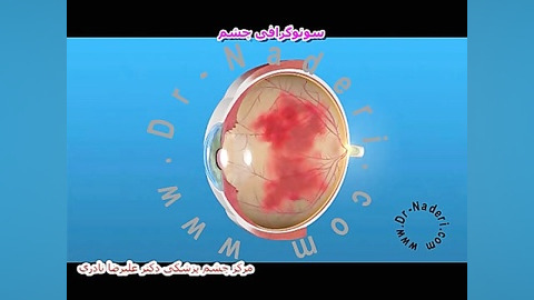 سونوگرافی شبکیه - مرکزچشم پزشکی دکتر علیرضا نادری مرکز چشم پزشکی دکتر علیرضا نادری www.dr-naderi.com