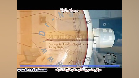 سوراخ ماکولا ی شبکیه - مرکزچشم پزشکی دکتر علیرضا نادری مرکز چشم پزشکی دکتر علیرضا نادری www.dr-naderi.com