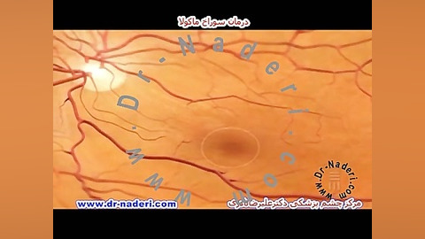 درمان سوراخ ماکولا - مرکزچشم پزشکی دکتر علیرضا نادری مرکز چشم پزشکی دکتر علیرضا نادری www.dr-naderi.com