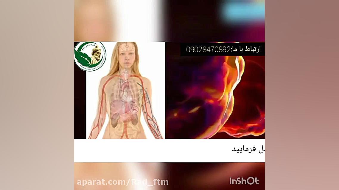 آيا عوارض بیماری ام اس را میدانید؟! آکنه