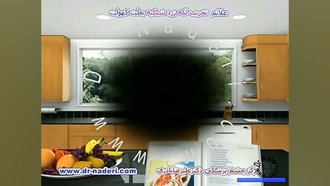 علائم تخریب سنی لکه زرد شبکیه-مرکزچشم پزشکی دکترنادری مرکز چشم پزشکی دکتر علیرضا نادری www.dr-naderi.com