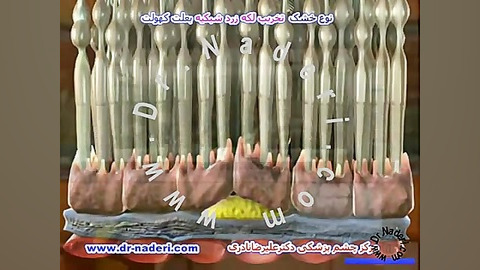 نوع خشک تخریب سنی لکه زرد شبکیه-مرکزچشم پزشکی دکترنادری مرکز چشم پزشکی دکتر علیرضا نادری www.dr-naderi.com