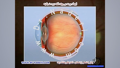 ایجاد غشاء روی لکه زرد شبکیه-مرکزچشم پزشکی دکترنادری مرکز چشم پزشکی دکتر علیرضا نادری www.dr-naderi.com
