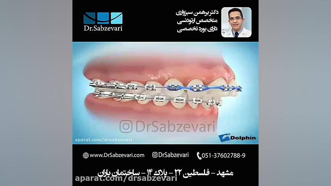 بستن فضاهای بین دندانی در ارتودنسی ثابت دکتر برهمن سبزواری - متخصص ارتودنسی - مشهد