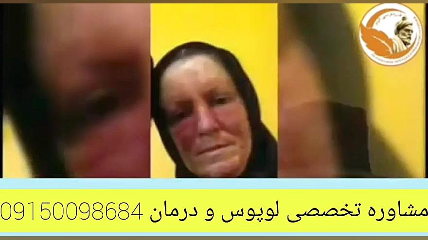 لوپوس و درمان جدید آن با گانودرما لیفت گردنایمپلنت دندان