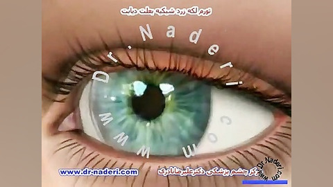 تورم ماکولا در دیابت - مرکزچشم پزشکی دکتر علیرضا نادری مرکز چشم پزشکی دکتر علیرضا نادری www.dr-naderi.com