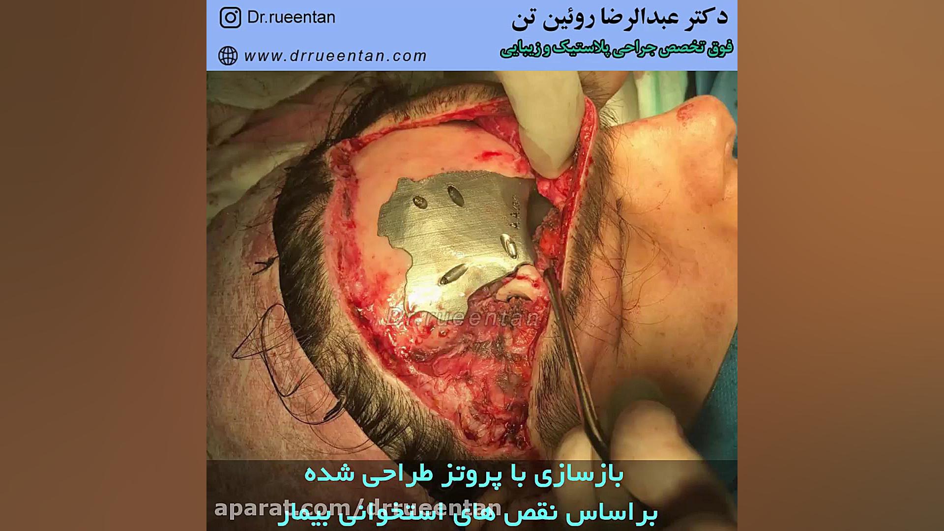 بازسازی ریم فوقانی اربیت و پیشانی بعلت تصادف دکتر عبدالرضا روئین تن