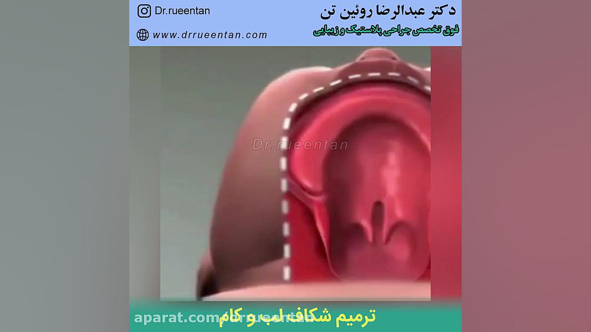 ترمیم شکاف لب و کام | فوق تخصص جراحی پلاستیک | دکتر عبدالرضا روئین تن دکتر عبدالرضا روئین تن
