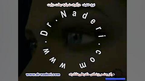 نوع خفیف اثر دیابت بر شبکیه - مرکزچشم پزشکی دکترنادری مرکز چشم پزشکی دکتر علیرضا نادری www.dr-naderi.com