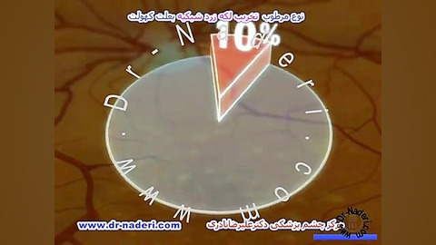 نوع مرطوب تخریب سنی لکه زرد - مرکزچشم پزشکی دکترنادری مرکز چشم پزشکی دکتر علیرضا نادری www.dr-naderi.com
