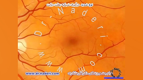 نوع شدید اثر دیابت بر شبکیه - مرکزچشم پزشکی دکترنادری مرکز چشم پزشکی دکتر علیرضا نادری www.dr-naderi.com