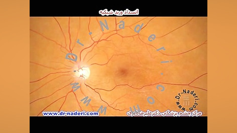 انسداد ورید شبکیه CRVO- مرکزچشم پزشکی دکتر علیرضا نادری مرکز چشم پزشکی دکتر علیرضا نادری www.dr-naderi.com