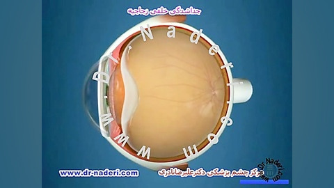 فلاشینگ یا جرقه های نورانی(PVD)- مرکز چشم دکتر نادری مرکز چشم پزشکی دکتر علیرضا نادری www.dr-naderi.com