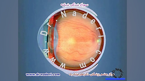 سوراخ شبکیهHole - مرکزچشم پزشکی دکتر علیرضا نادری مرکز چشم پزشکی دکتر علیرضا نادری www.dr-naderi.com