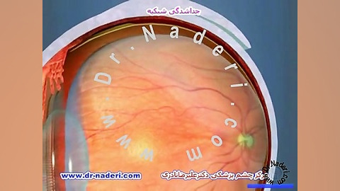 جداشدگی شبکیه Detachment-مرکزچشم پزشکی دکترعلیرضانادری مرکز چشم پزشکی دکتر علیرضا نادری www.dr-naderi.com
