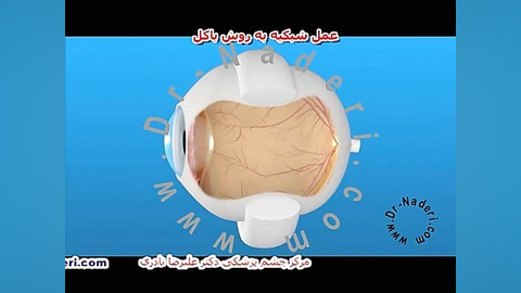 عمل اسکلرال باکل شبکیه -مرکزچشم پزشکی دکتر علیرضا نادری مرکز چشم پزشکی دکتر علیرضا نادری www.dr-naderi.com